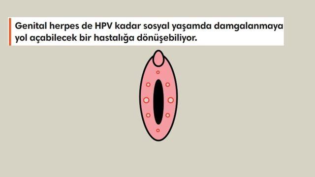 Cinsellikle Bulaşan ve Hayatınızı En Az HPV Kadar Olumsuz Etkileyen ’HSV Virüsü’ Hakkında Bilmeniz Gerekenler