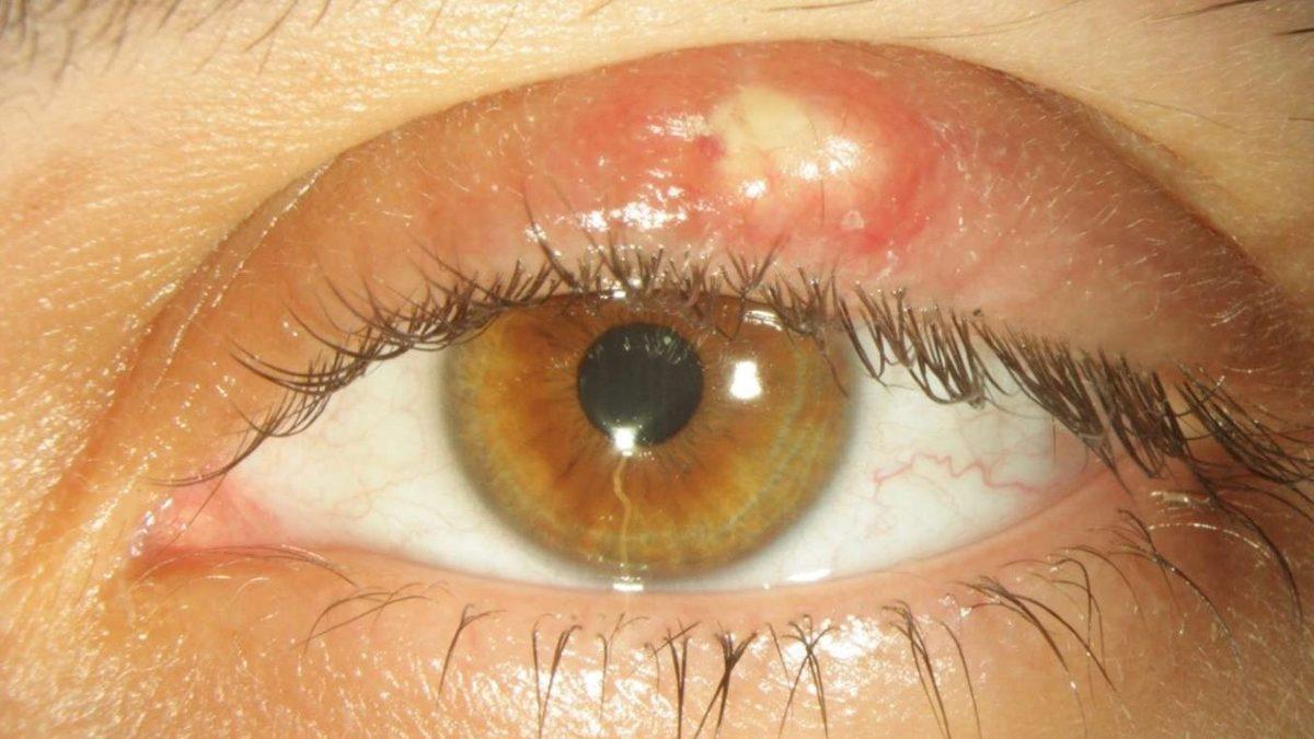 Ucuz Güneş Gözlüklerinin Gözünüze Verdiği Zararları Öğrenince Kullanmaya Tövbe Edeceksiniz!