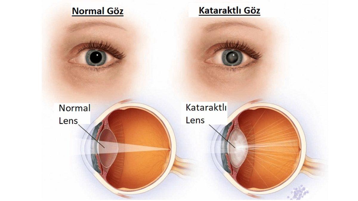Ucuz Güneş Gözlüklerinin Gözünüze Verdiği Zararları Öğrenince Kullanmaya Tövbe Edeceksiniz!