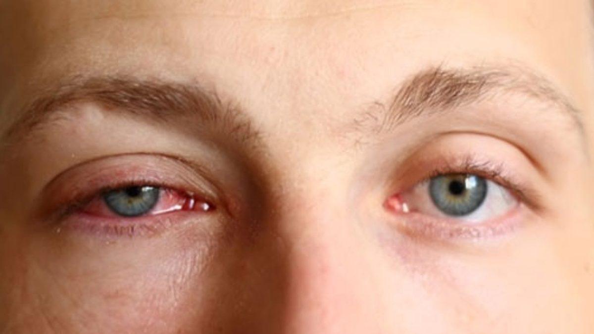 Ucuz Güneş Gözlüklerinin Gözünüze Verdiği Zararları Öğrenince Kullanmaya Tövbe Edeceksiniz!