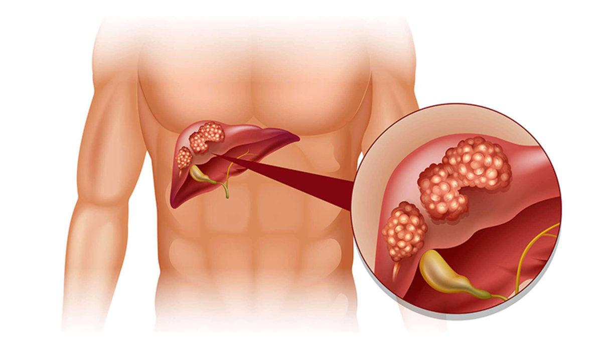 Yeni Yüksek Riskli Bir Kanser Tipi Ortaya Çıktı: Kemoterapiye Bile Yanıt Vermiyor
