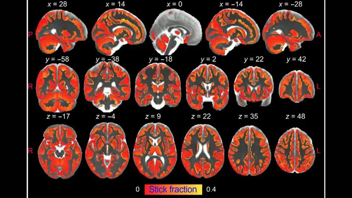 Beyin İltihabı İlk Kez Görüntülendi: Parkinson, Alzheimer Gibi Hastalıklar İçin Altın Değerinde Keşif…