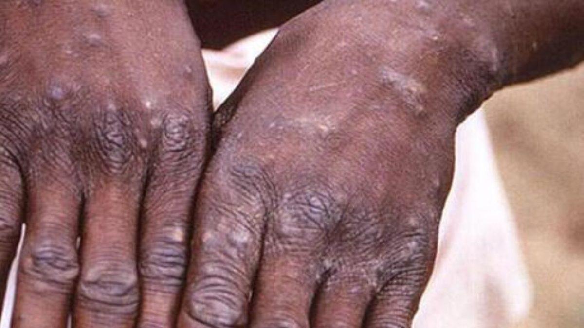 Yine mi: Dünya Sağlık Örgütü, Maymun Çiçeği Salgını İçin Küresel Acil Durum İlan Etti