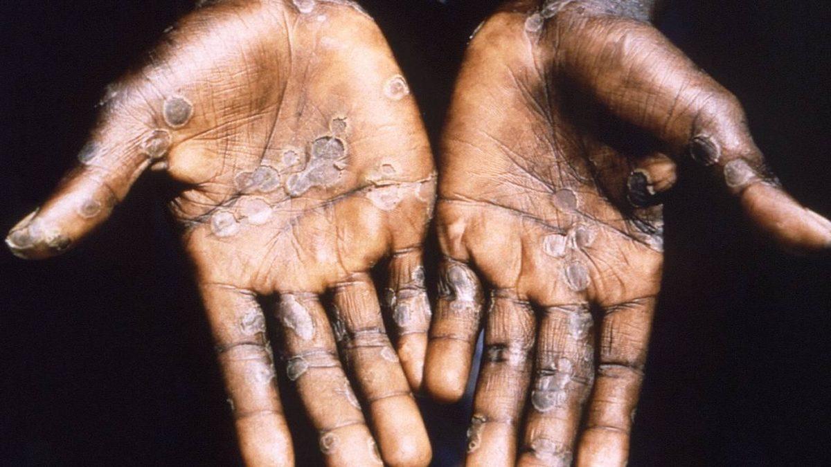 Yine mi: Dünya Sağlık Örgütü, Maymun Çiçeği Salgını İçin Küresel Acil Durum İlan Etti