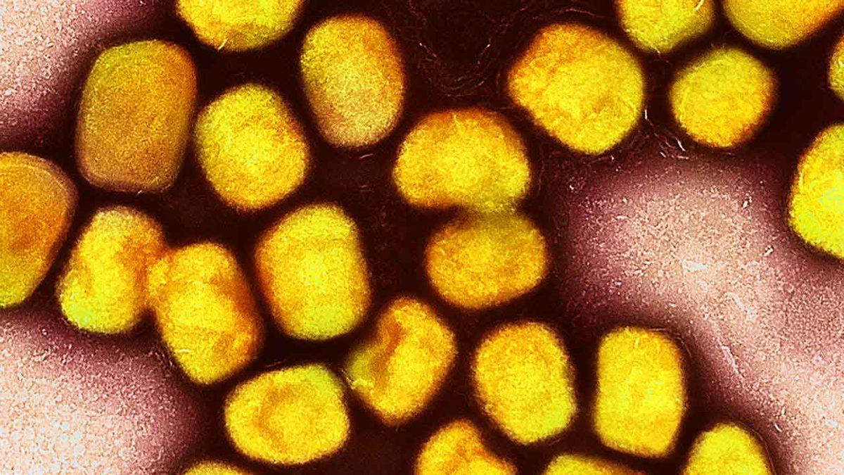 Şoke Eden Araştırma: Maymun Çiçeği Virüsü Vakalarının Yüzde 98’i Eşcinsel ya da Biseksüel Erkek!