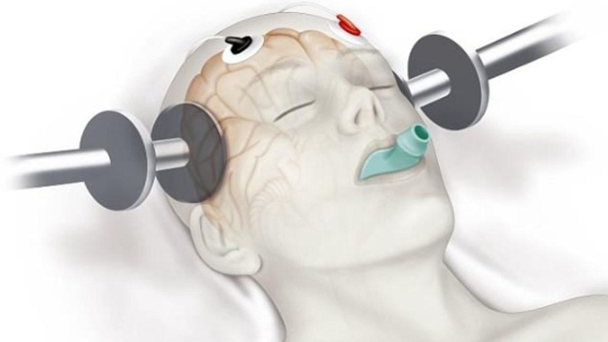 Akıl Hastalarına Uygulanabilen ve Asla Olmak İstemeyeceğiniz Psikolojik Tedavi: Elektroşok