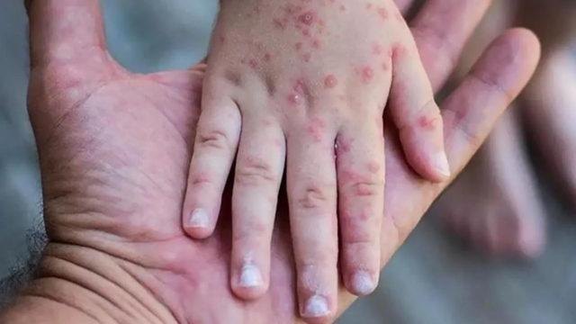 Afrika Hastalık Önleme ve Kontrol Merkezi: Kıtadaki Maymun Çiçeği Vakalarının Eşcinsellikle İlgisi Yok