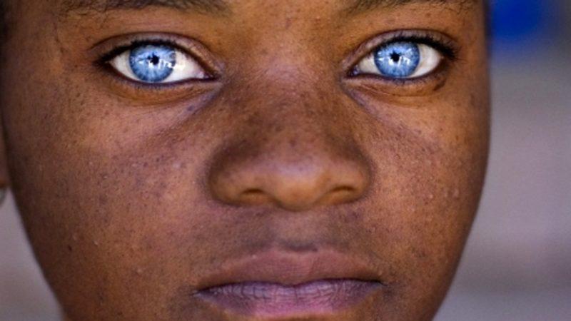 Siyahi İnsanlarda Mavi Göz Görülmesinin Öğrenince Bilime Hayran Bırakan İlginç Nedeni