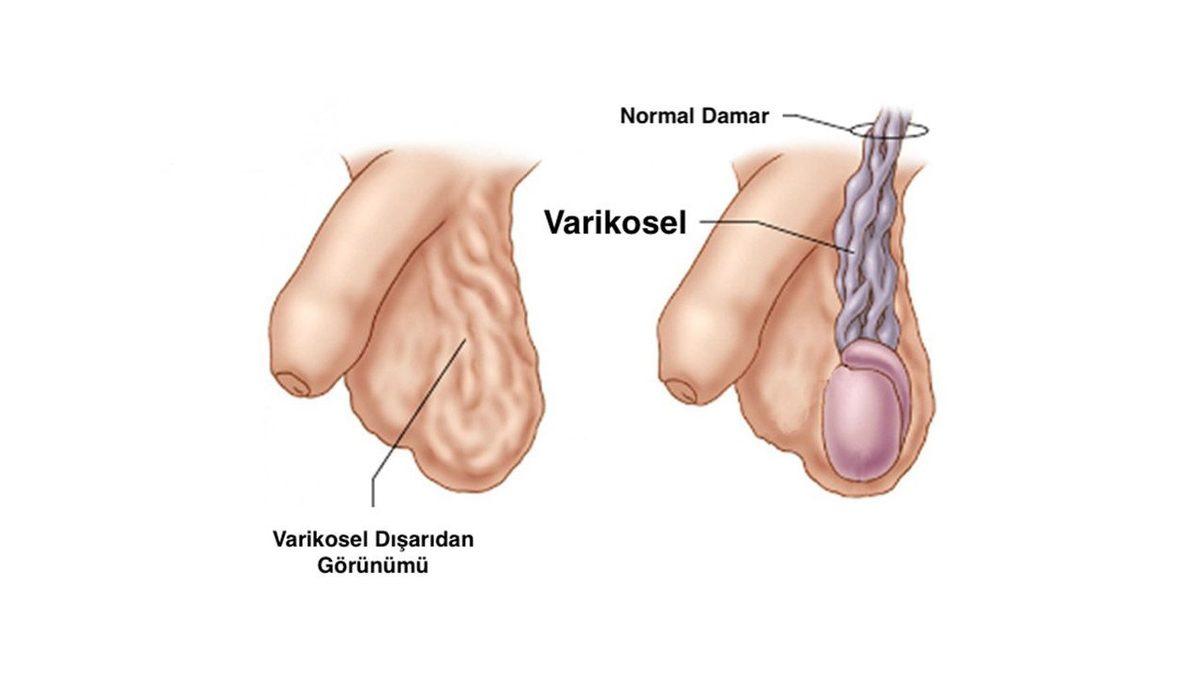 Çoğu Zaman Semptom Göstermeyen Ancak Ciddi Sorunlara Yol Açabilen ’Varikosel’ Nedir, Neden Olur? Belirtileri ve Tedavi Yöntemleri
