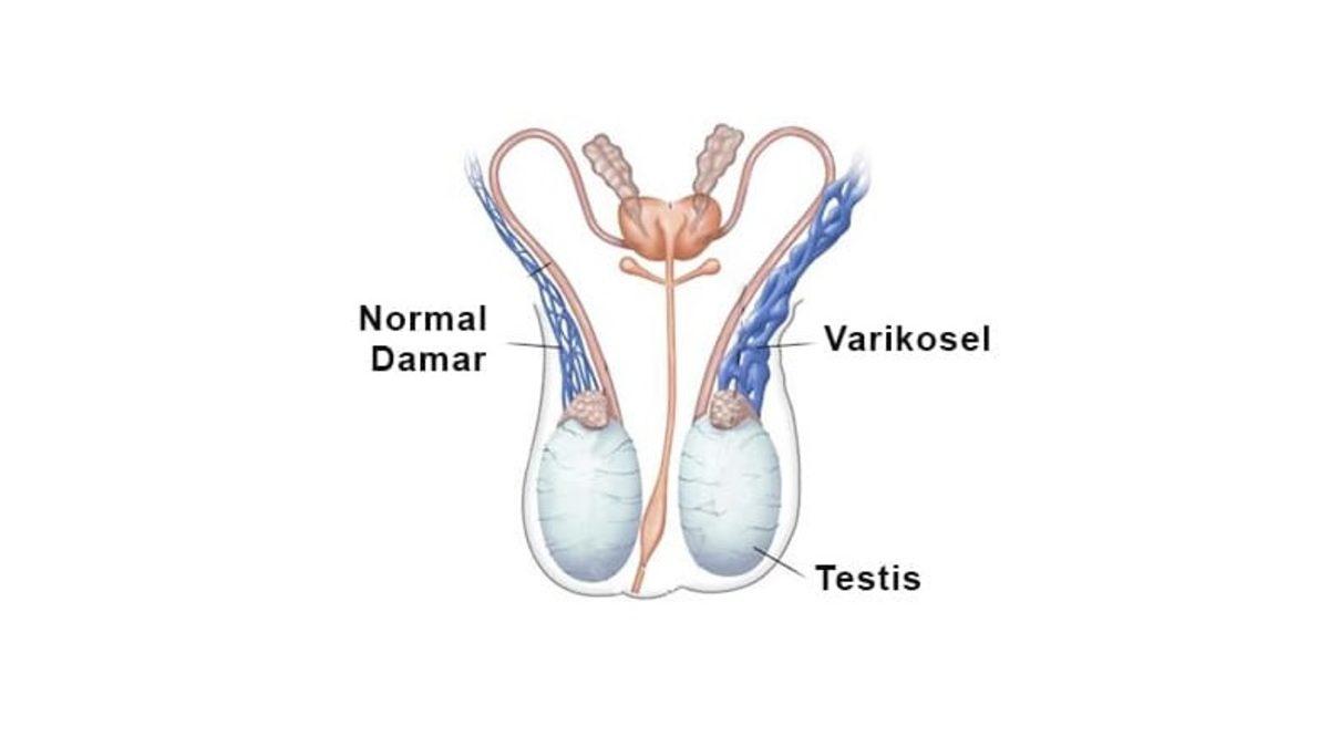 Çoğu Zaman Semptom Göstermeyen Ancak Ciddi Sorunlara Yol Açabilen ’Varikosel’ Nedir, Neden Olur? Belirtileri ve Tedavi Yöntemleri