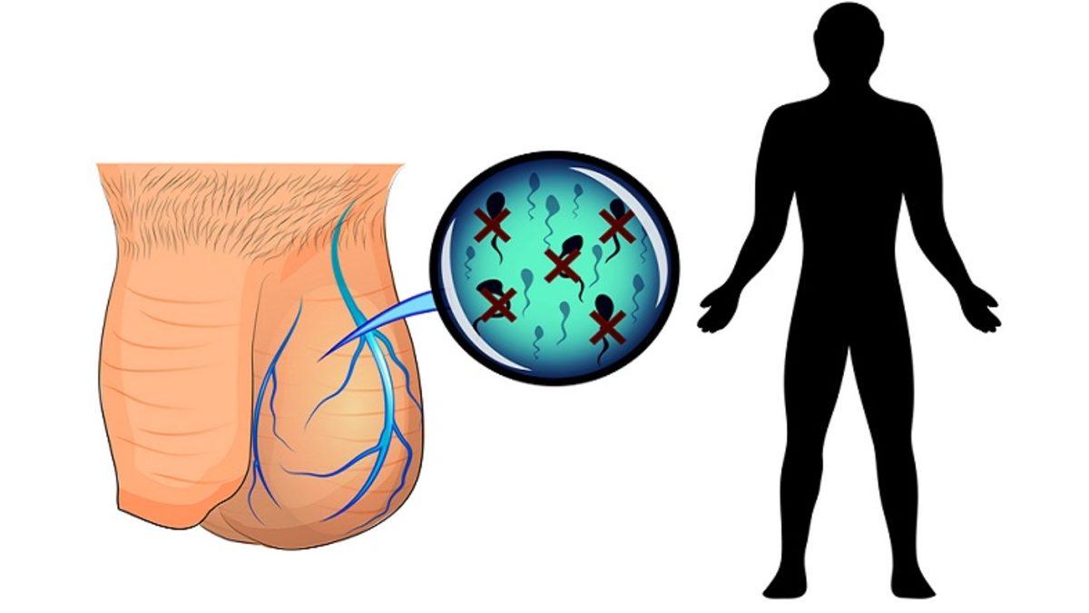 Çoğu Zaman Semptom Göstermeyen Ancak Ciddi Sorunlara Yol Açabilen ’Varikosel’ Nedir, Neden Olur? Belirtileri ve Tedavi Yöntemleri