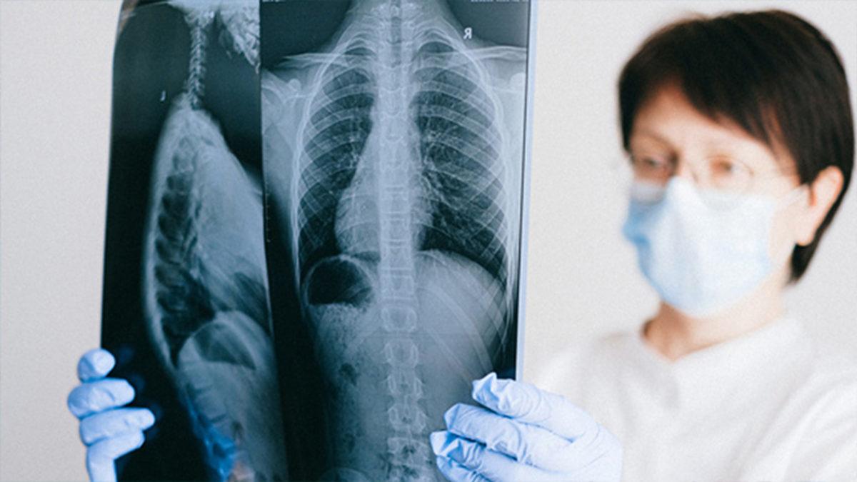 Doç. Dr. Savaşçı: Koronavirüs Tedavisi, Veremi Aktif Hale Getirebiliyor