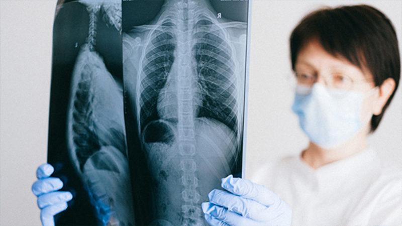 Doç. Dr. Savaşçı: Koronavirüs Tedavisi, Veremi Aktif Hale Getirebiliyor