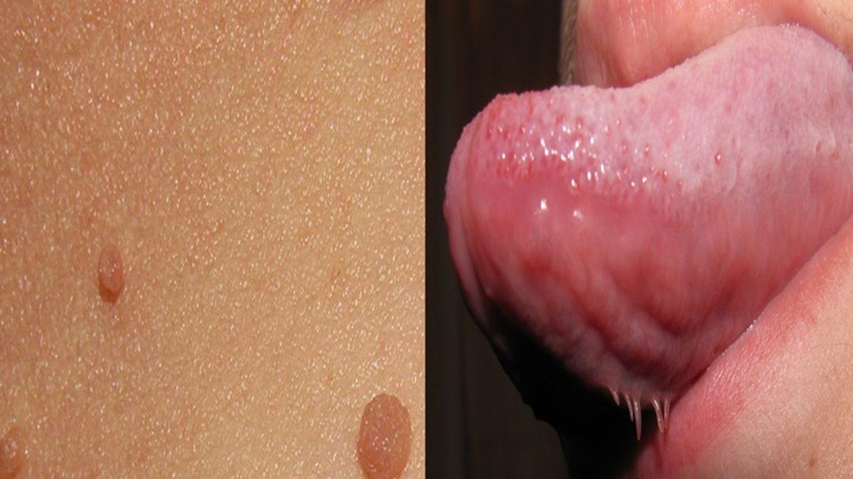 Bazı Kişilerin Dilinin Altında Çıkan Bu Tuhaf Şeyler Neyin Nesidir?