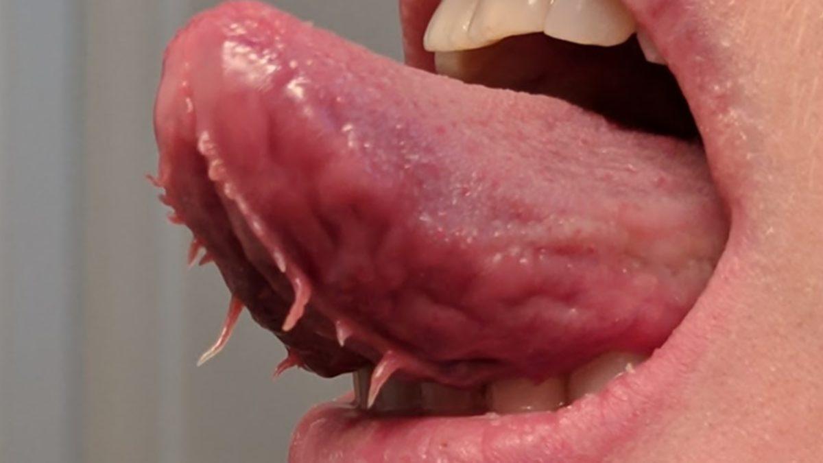 Bazı Kişilerin Dilinin Altında Çıkan Bu Tuhaf Şeyler Neyin Nesidir?