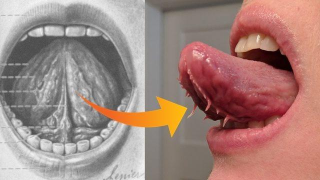 Bazı Kişilerin Dilinin Altında Çıkan Bu Tuhaf Şeyler Neyin Nesidir?