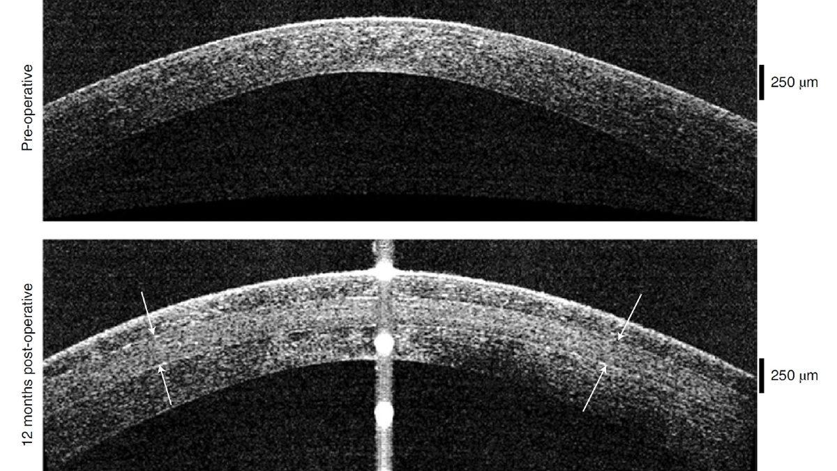 Domuz Derisinden Yapılan İmplantlarla Görme Engelli Bireylerin Yeniden Görmesi Sağlandı: Kornea Nakli Kadar Etkili!