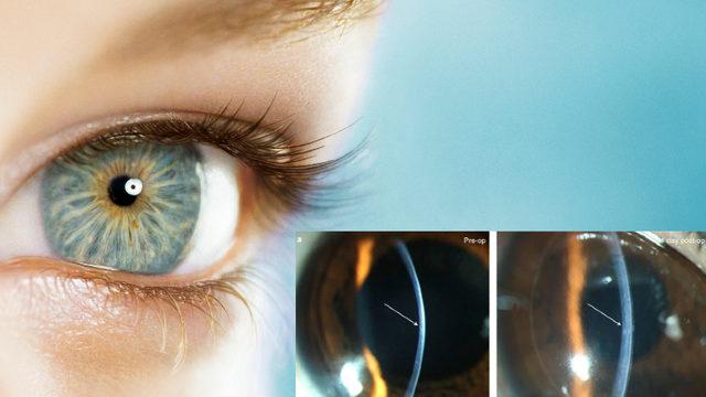 Domuz Derisinden Yapılan İmplantlarla Görme Engelli Bireylerin Yeniden Görmesi Sağlandı: Kornea Nakli Kadar Etkili!