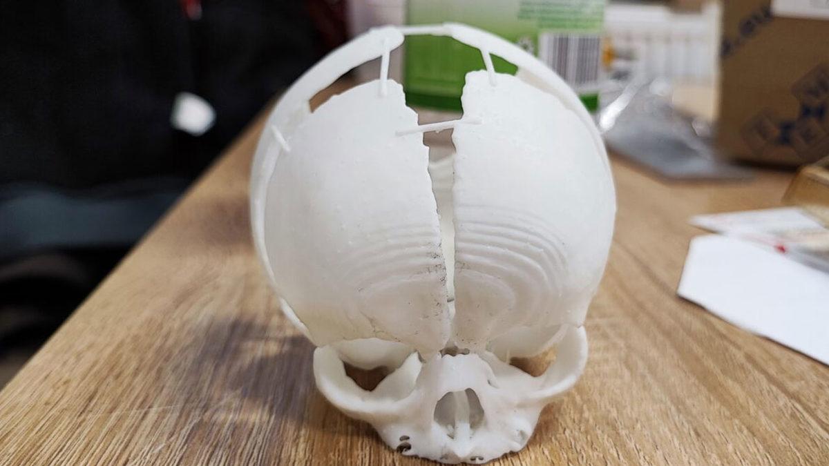 Kafatası Olmadan Doğan Bebek, 3D Yazıcıda Üretilen Yapay Kafatası ile Hayatta Kaldı