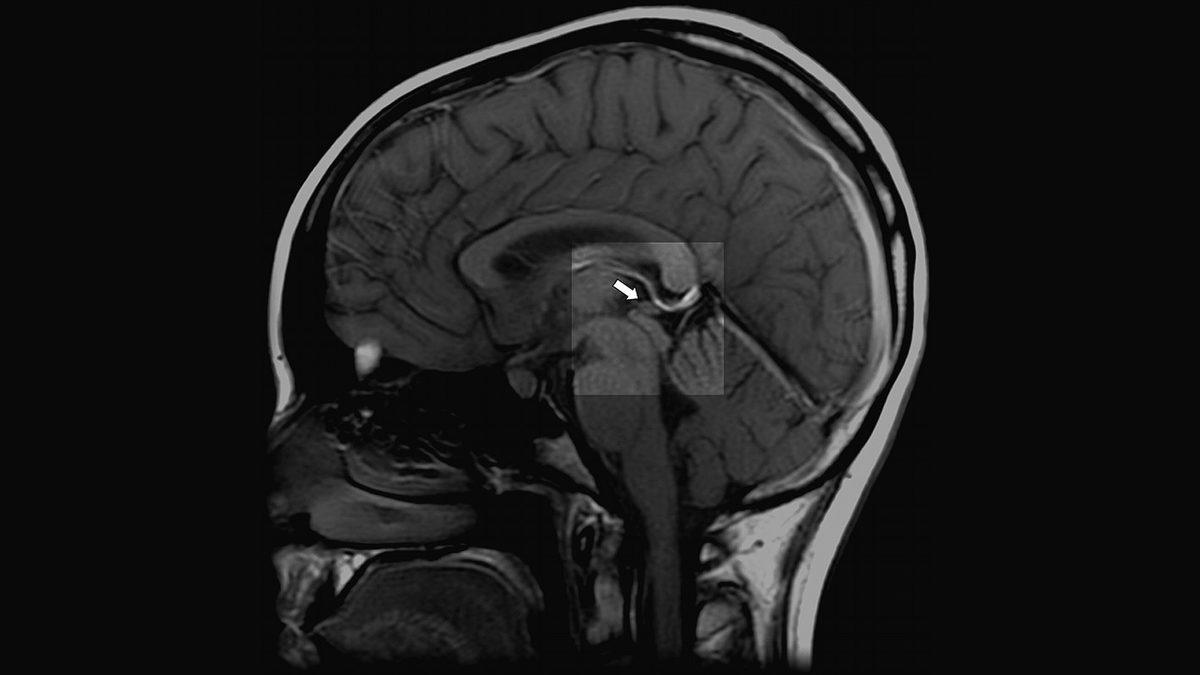 Beyninizde ‘Ruhun Tahtı’ Olarak Anılan Bir Yer Var: Epifiz Bezi Nedir, Nasıl Çalışıyor?