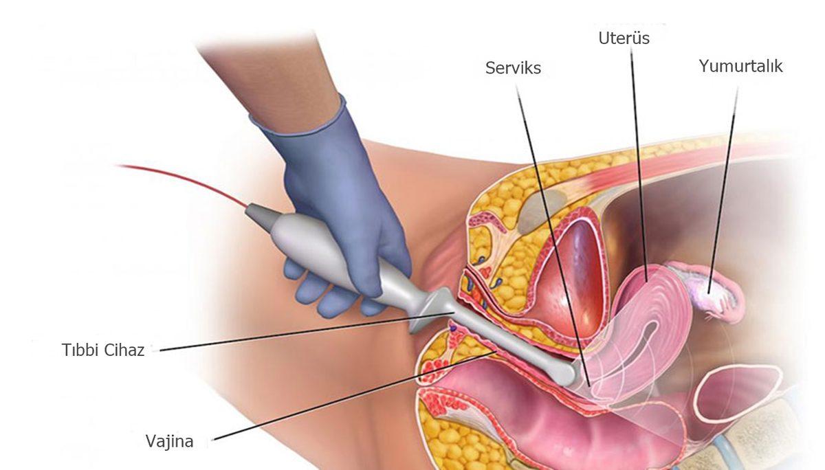 Vajinismus ile İlgili İnternette Okuduğunuz Çoğu Bilgi Yanlış! Doğrusunu Öğrenmeniz İçin Konuyu Bir Kadın Hastalıkları Uzmanına Sorduk