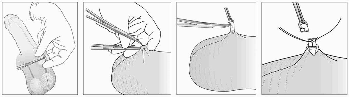 Erkeklere Uygulanan Kısırlaştırma Sonrasında Spermler Nereye Gidiyor?