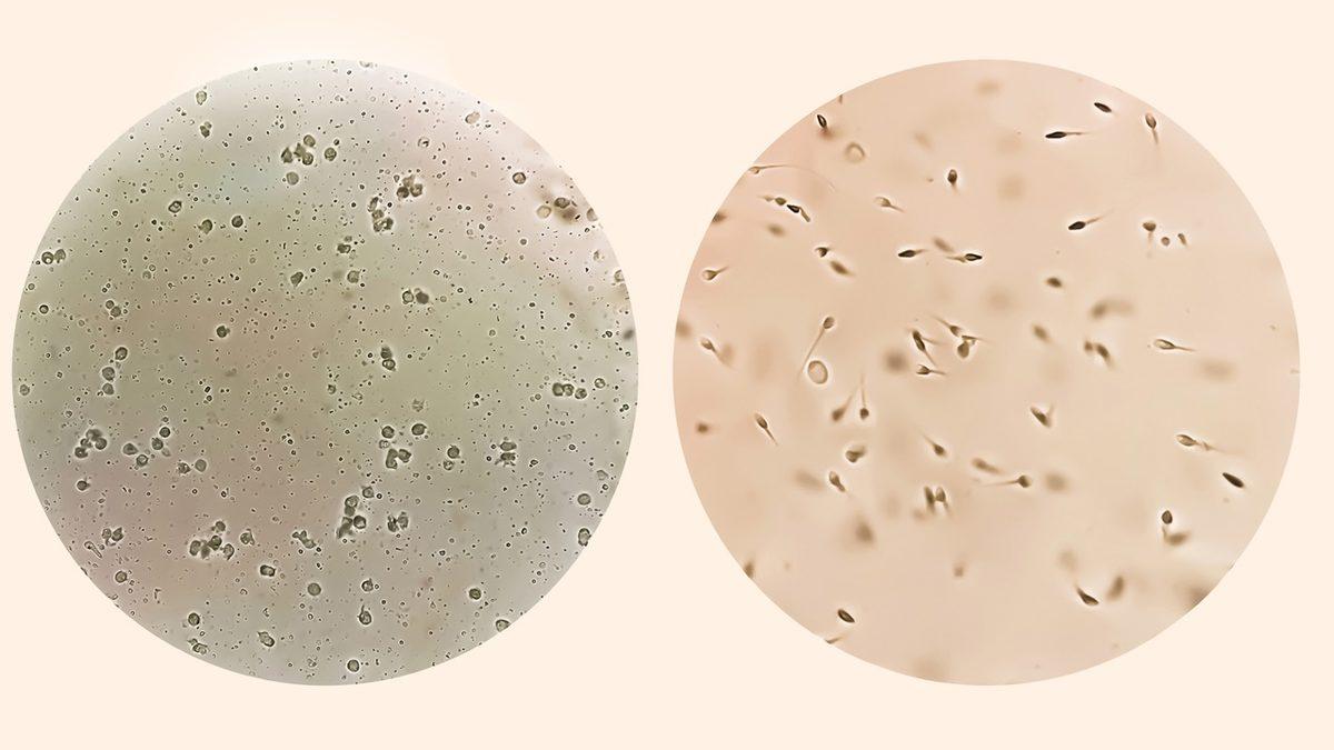 Erkeklere Uygulanan Kısırlaştırma Sonrasında Spermler Nereye Gidiyor?