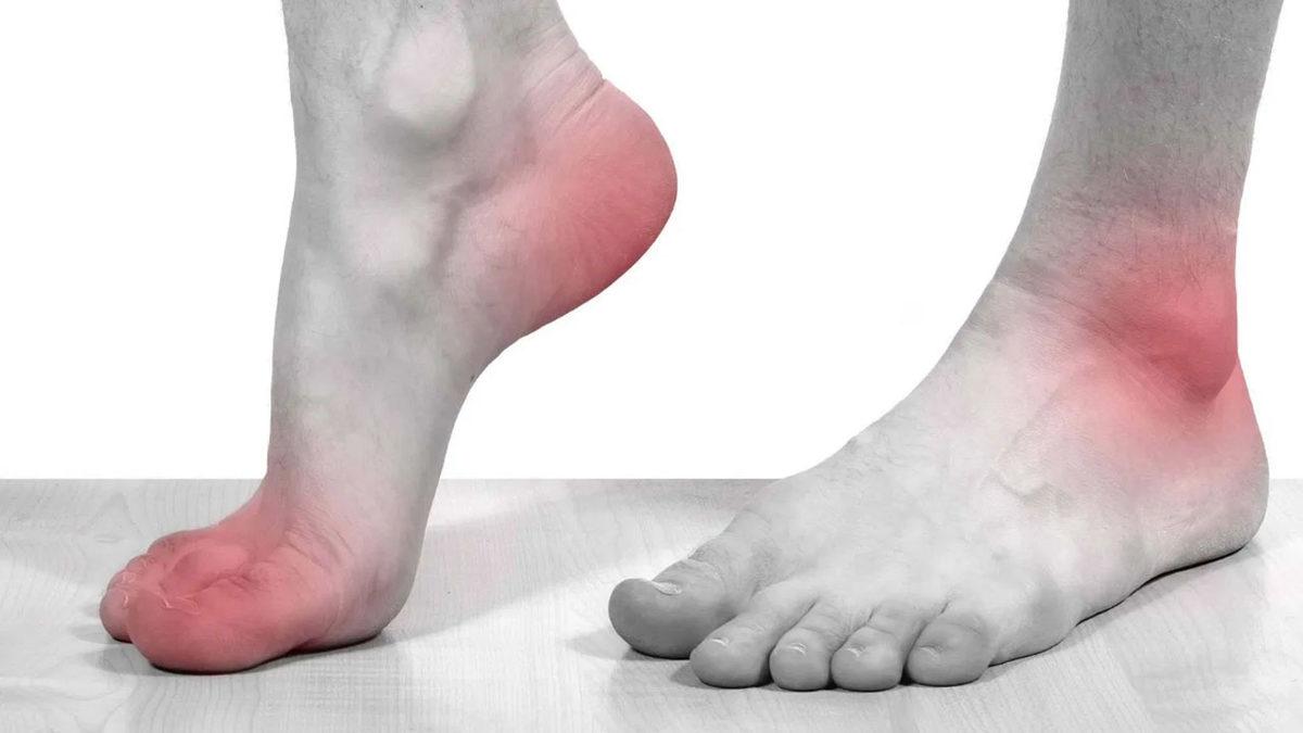 Özellikle Geceleri Ortaya Çıkıp Dayanılmaz Olabilen ’Ayak Yanması’ Aslında Neden Olur, Ne İyi Gelir?