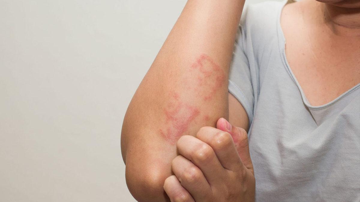 Özellikle Geceleri Ortaya Çıkıp Dayanılmaz Olabilen ’Ayak Yanması’ Aslında Neden Olur, Ne İyi Gelir?