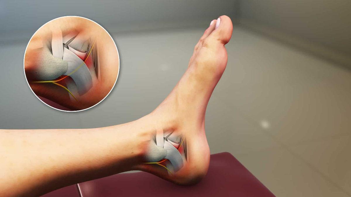 Özellikle Geceleri Ortaya Çıkıp Dayanılmaz Olabilen ’Ayak Yanması’ Aslında Neden Olur, Ne İyi Gelir?