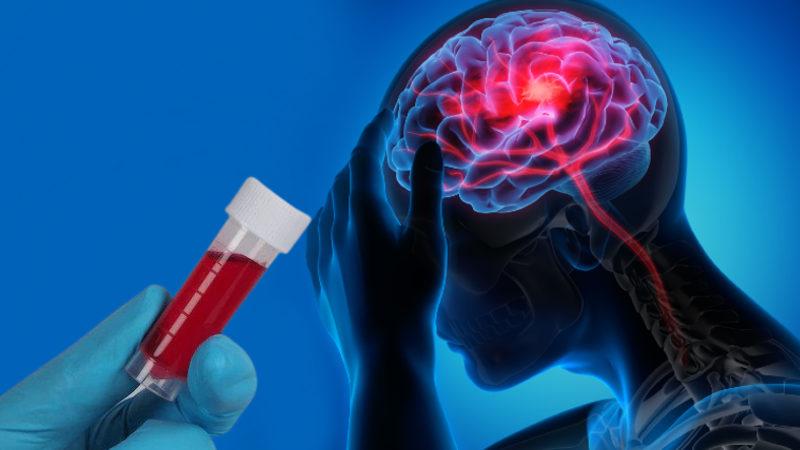 Bazı Kan Gruplarının Erken Yaşta Felç Geçirme Riskini Artırdığı Ortaya Çıktı