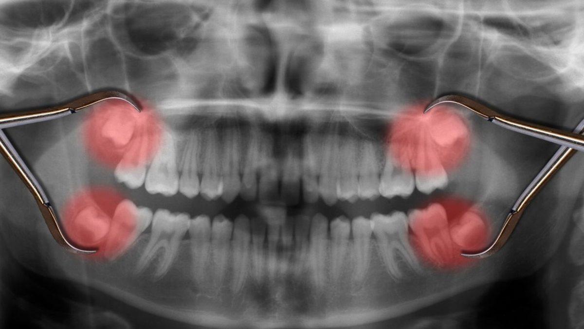 Yirmilik Dişlerimiz Neden Çocukken Değil de Yetişkinlikte Çıkıyor?