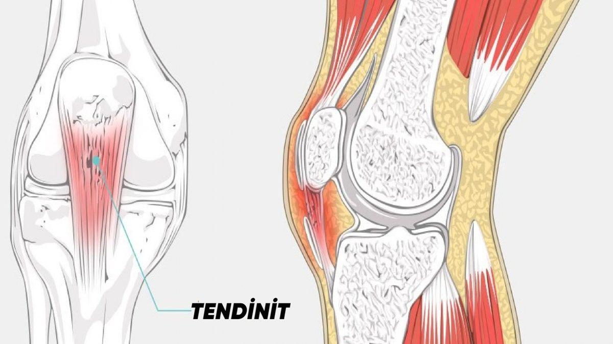 Halk Arasında ’Tenisçi Dirseği’ Olarak Bilinen Rahatsızlık: Tendinit Nedir, Belirtileri Nelerdir?