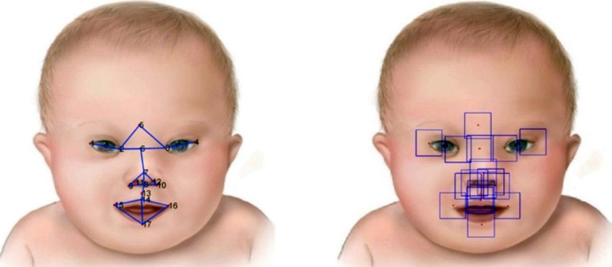Bir Genetik Mühendisine Sorduk: Down Sendromlu Bireylerin Yüzleri Neden Birbirine Benzer?
