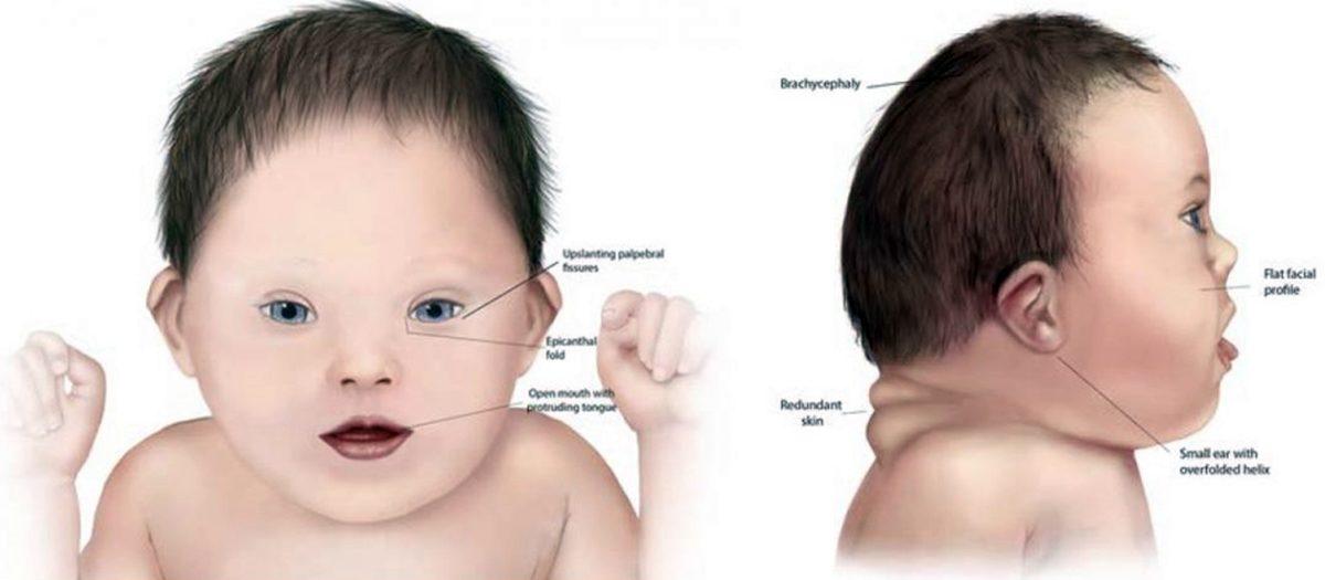 Bir Genetik Mühendisine Sorduk: Down Sendromlu Bireylerin Yüzleri Neden Birbirine Benzer?