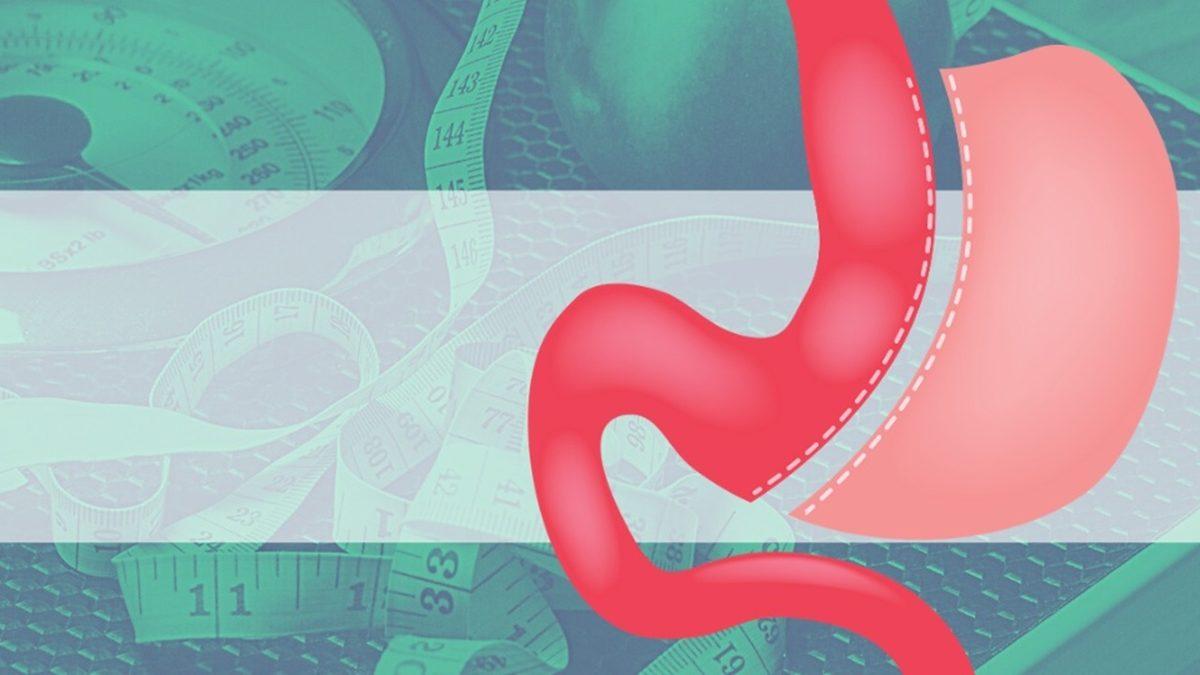 Tüp Mide Ameliyatı Sayesinde 30 Kilo Veren Birine Bu Süreçte Yaşadıklarını Sorduk: Midenin Bir Kısmının Alınması Nasıl Bir His?