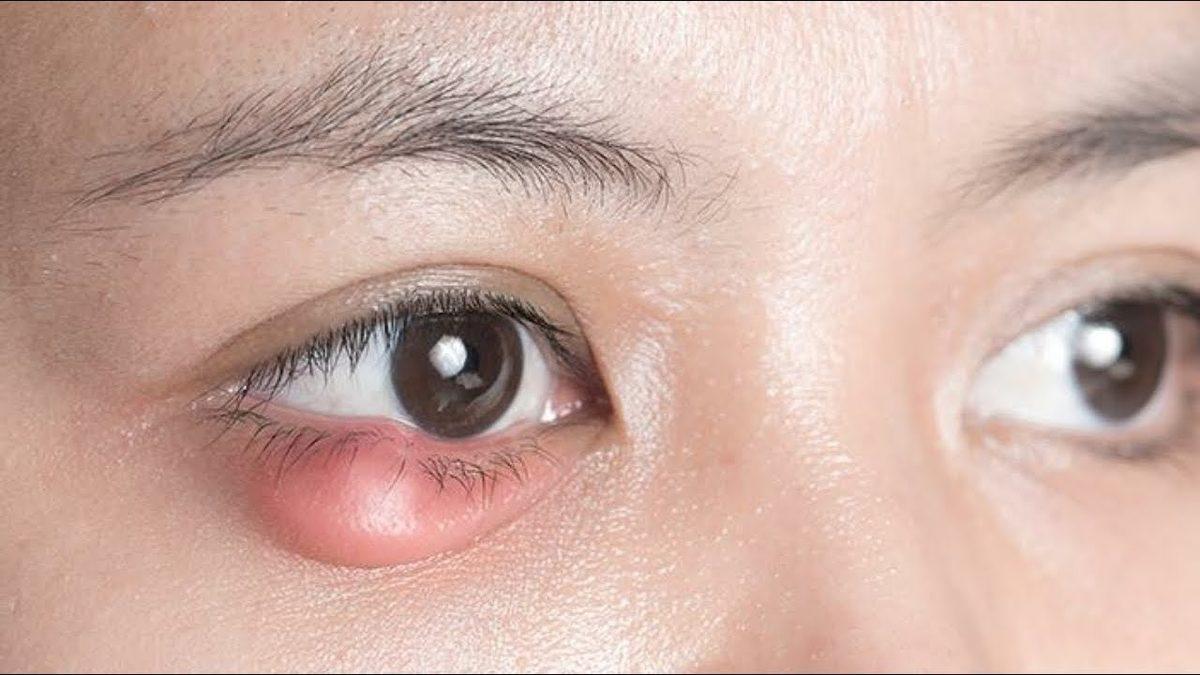 Göz Kapağımızda Çıkan ve İyileşene Dek Canımızdan Bezdiren ’Arpacık’ Aslında Neden Olur?