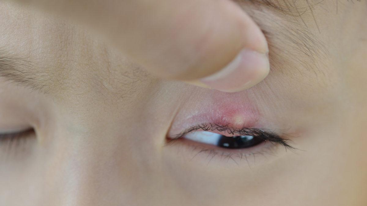 Göz Kapağımızda Çıkan ve İyileşene Dek Canımızdan Bezdiren ’Arpacık’ Aslında Neden Olur?