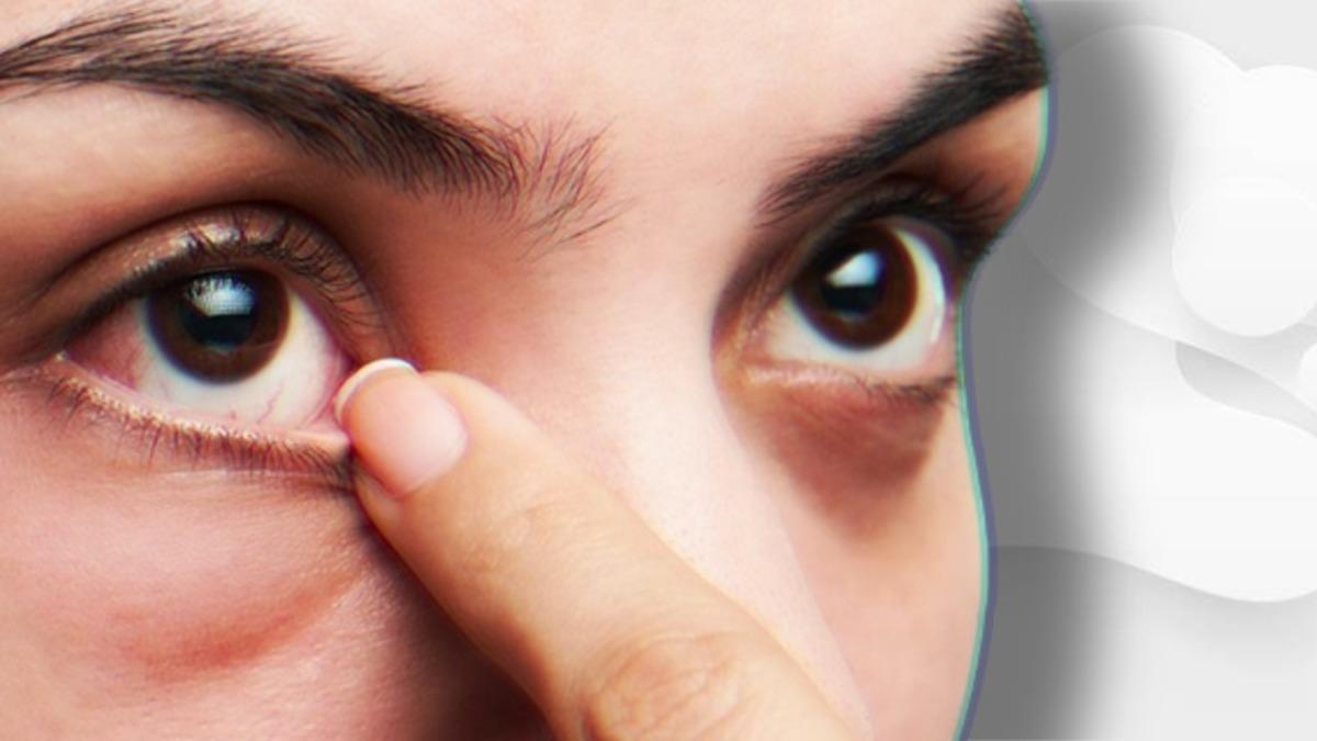 Göz Kapağımızda Çıkan ve İyileşene Dek Canımızdan Bezdiren ’Arpacık’ Aslında Neden Olur?