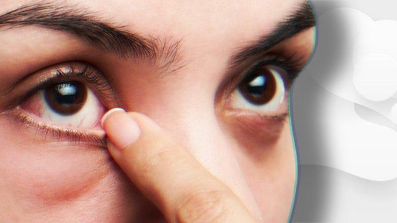 Göz Kapağımızda Çıkan ve İyileşene Dek Canımızdan Bezdiren ’Arpacık’ Aslında Neden Olur?