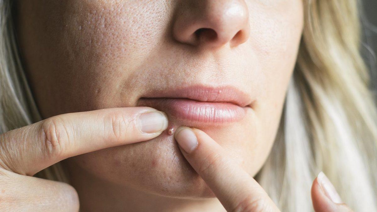 Özellikle Ergenlik Döneminde Hepimizin Baş Belası Olan ’Sivilce’ Aslında Neden Çıkar, Nasıl Geçer?