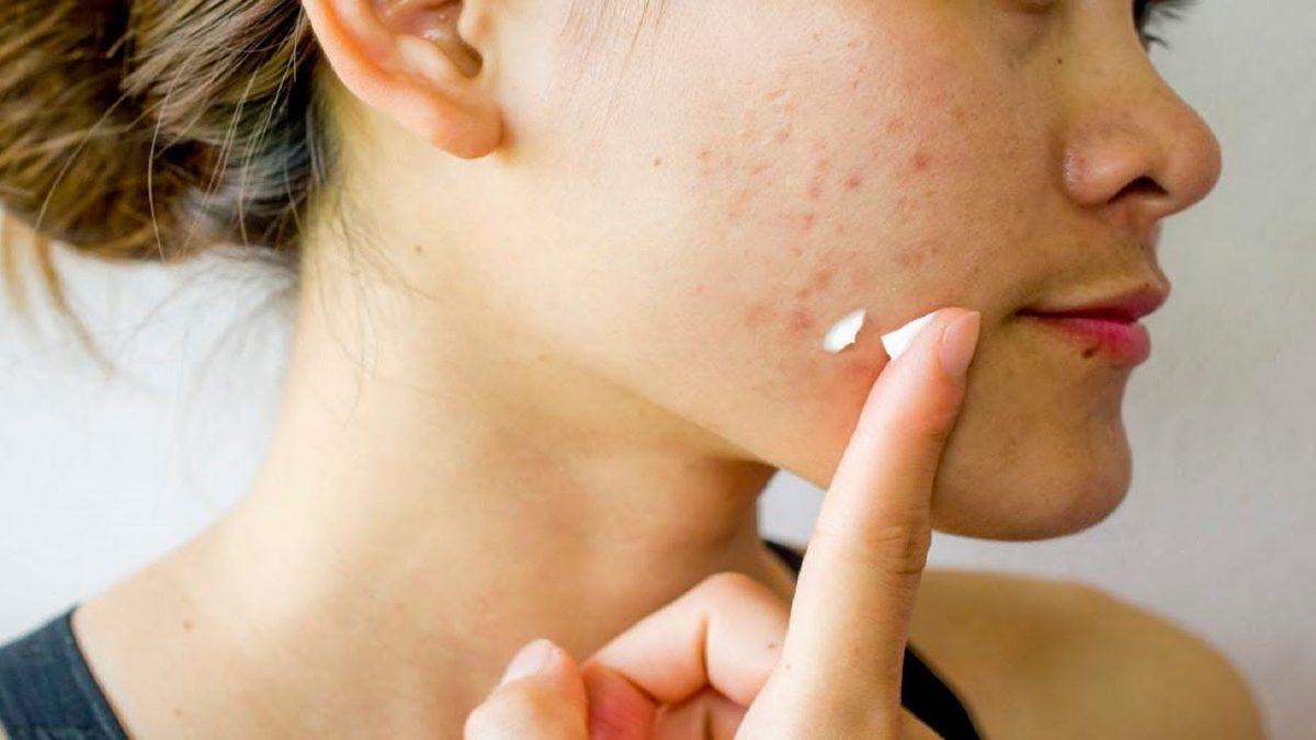 Özellikle Ergenlik Döneminde Hepimizin Baş Belası Olan ’Sivilce’ Aslında Neden Çıkar, Nasıl Geçer?