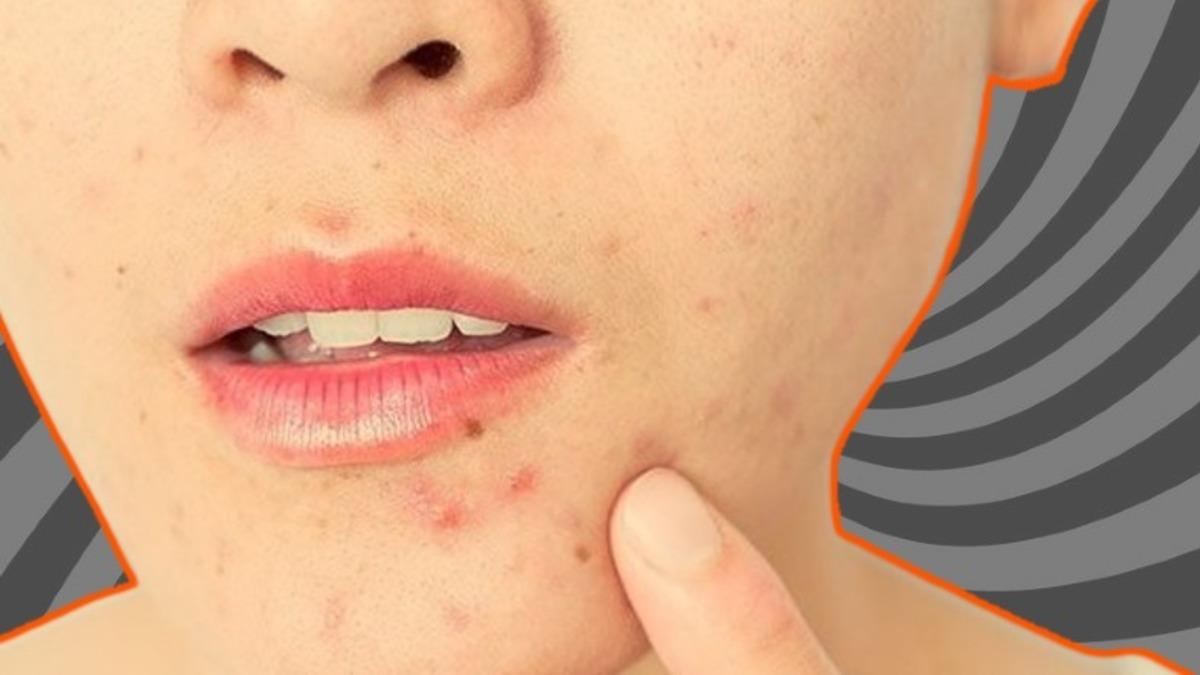 Özellikle Ergenlik Döneminde Hepimizin Baş Belası Olan ’Sivilce’ Aslında Neden Çıkar, Nasıl Geçer?