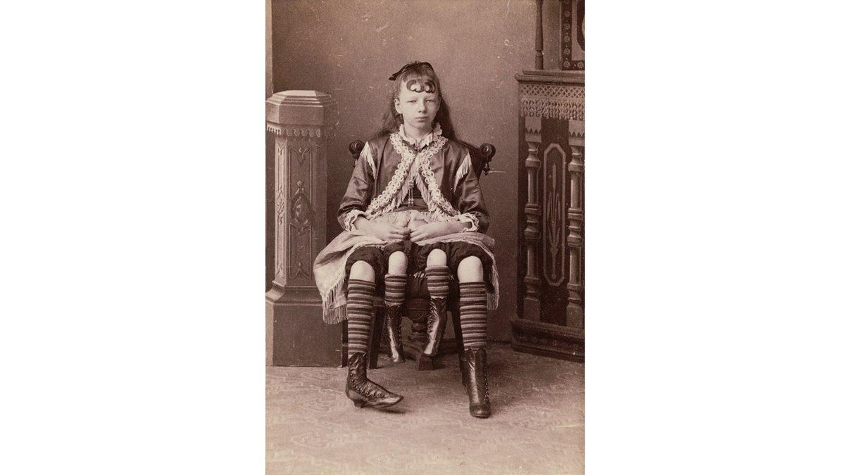 Dört Bacak ve İki Rahimle Doğan Kadın Myrtle Corbin’in Akıl Almayacak Hayat Hikayesi