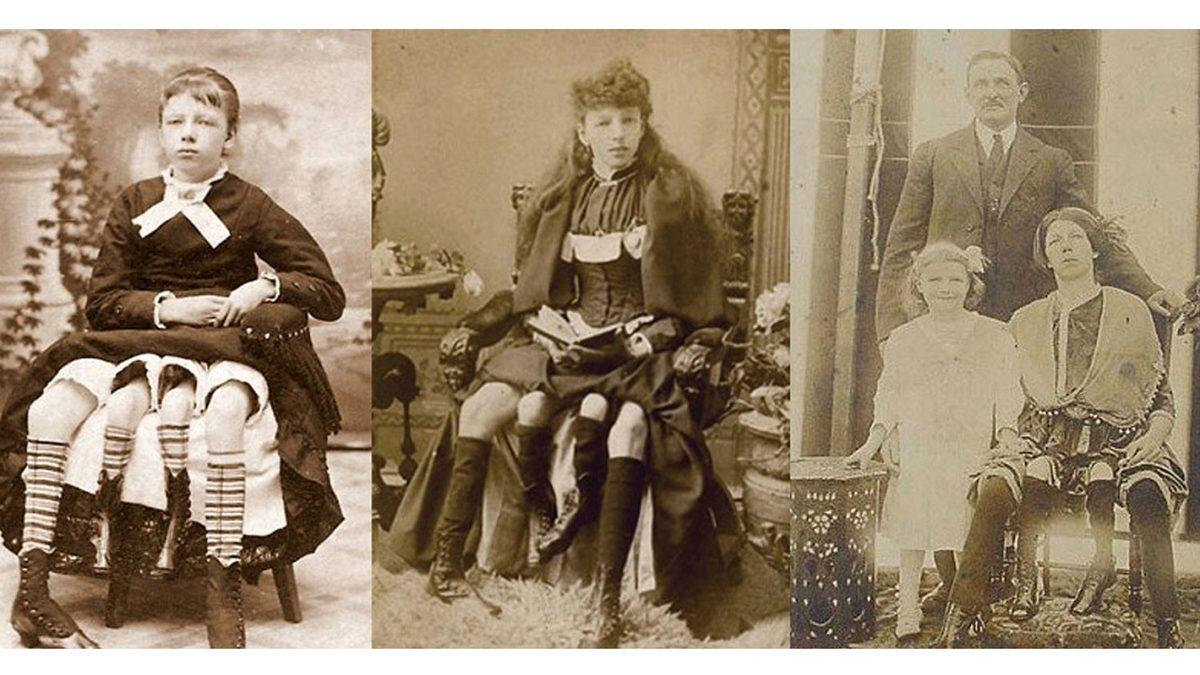 Dört Bacak ve İki Rahimle Doğan Kadın Myrtle Corbin’in Akıl Almayacak Hayat Hikayesi