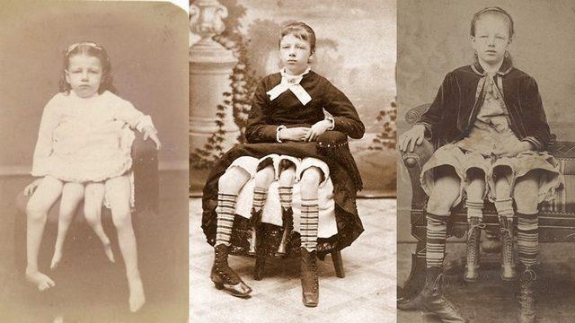 Dört Bacak ve İki Rahimle Doğan Kadın Myrtle Corbin’in Akıl Almayacak Hayat Hikayesi