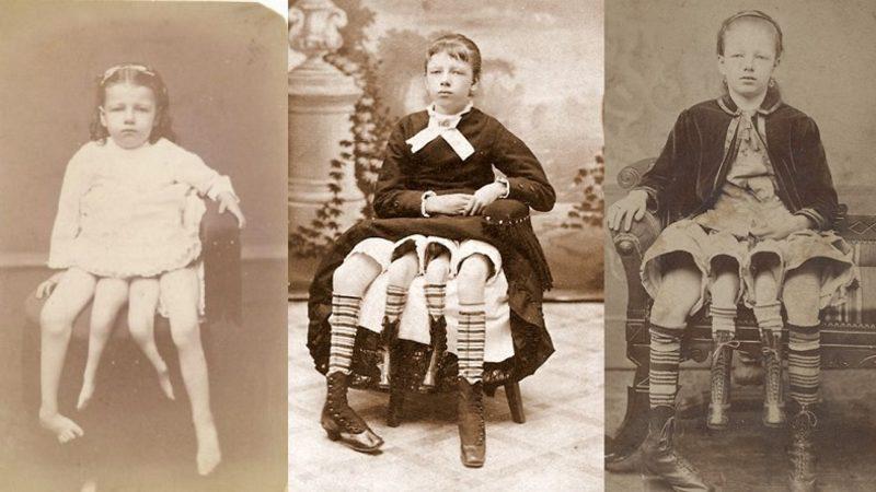 Dört Bacak ve İki Rahimle Doğan Kadın Myrtle Corbin’in Akıl Almayacak Hayat Hikayesi