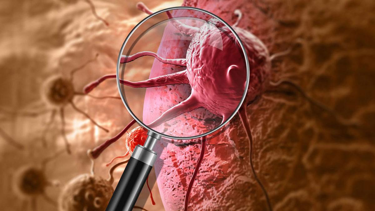 Kanser Hücrelerini Öldüren Virüs Geliştirildi: Tümörü Tamamen Yok Etti!