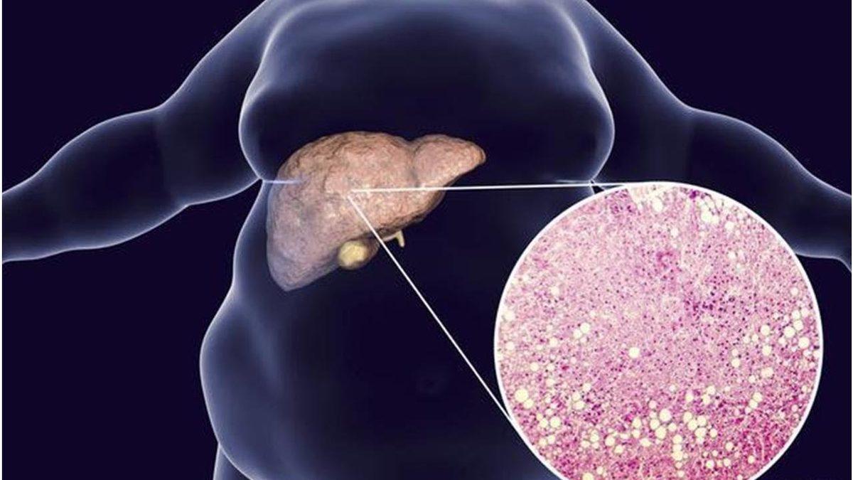 Karaciğerimizin Sağlıklı Bir Şekilde Çalışıp Çalışmadığını Gösteren ’AST’ Nedir, Yüksekliği ve Düşüklüğü Ne Anlama Gelir?