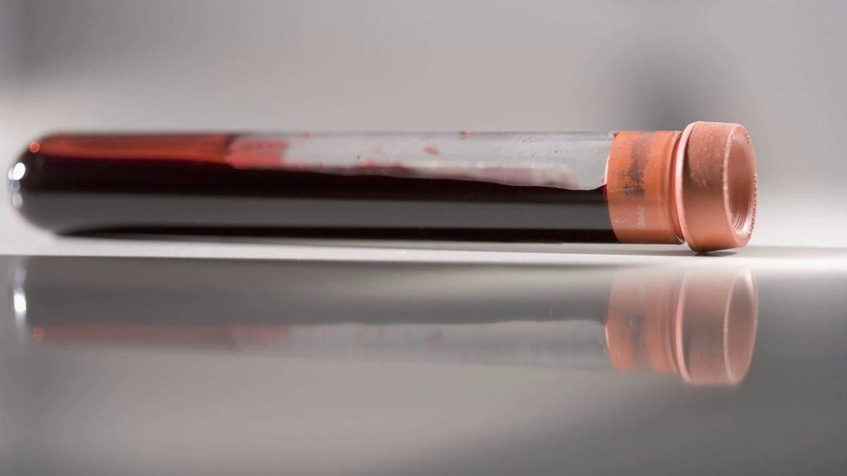 Karaciğerimizin Sağlıklı Bir Şekilde Çalışıp Çalışmadığını Gösteren ’AST’ Nedir, Yüksekliği ve Düşüklüğü Ne Anlama Gelir?